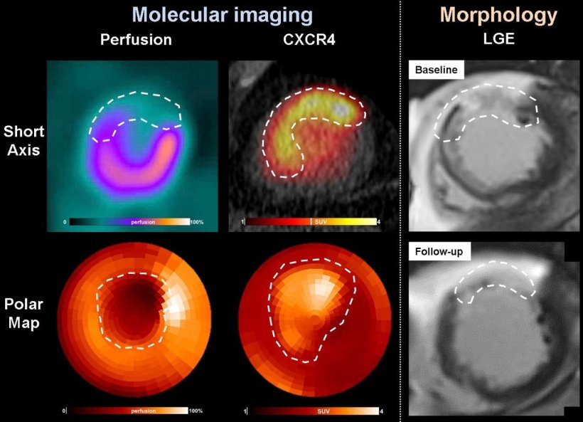 Example of 68-year-old male patient with anterior ST-segment elevation...