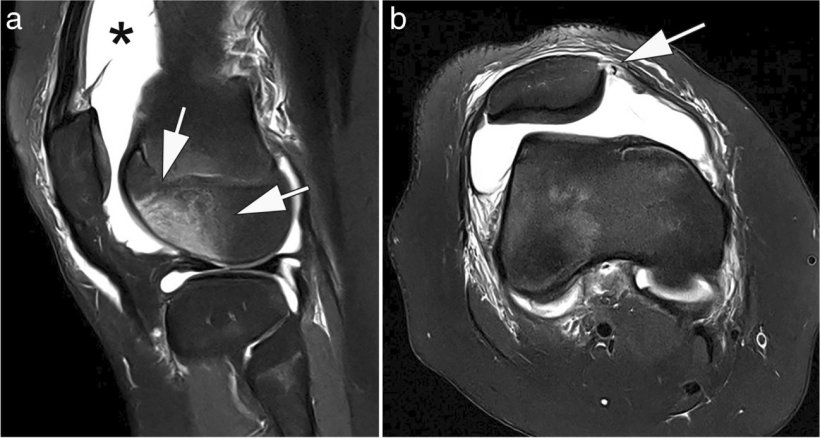 Two MRI images of a girls knee with dislocated patella