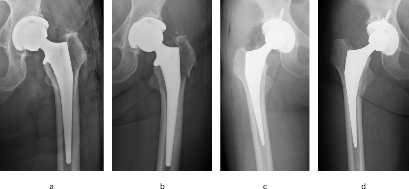 Four xray images of hips with replacement implants