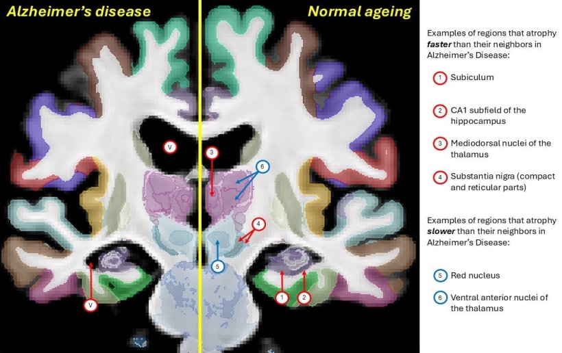 Labelled brain MRI scans of patients with Alzheimers disease (left) and healthy...