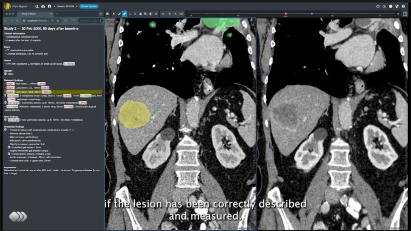 Screenshot einer KI-Software zur automatischen Segmentierung von CT-Aufnahmen....
