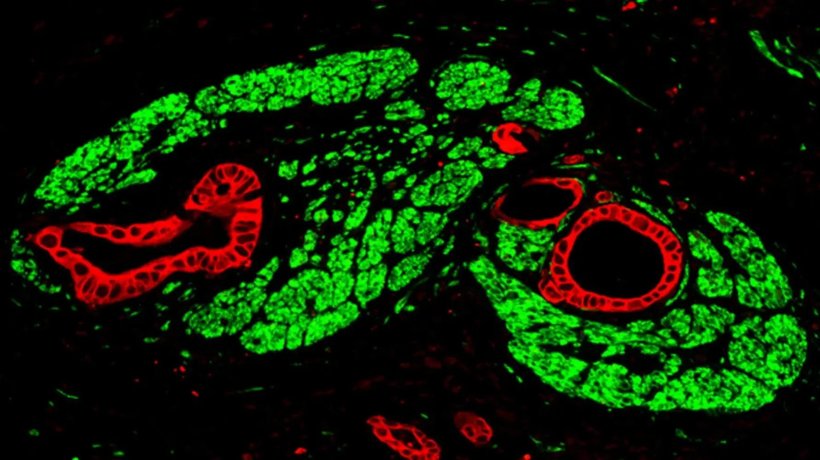 Bauchspeicheldrüsenkrebs in einer Immunofluoreszenz-Aufnahme: Die Tumorzellen...