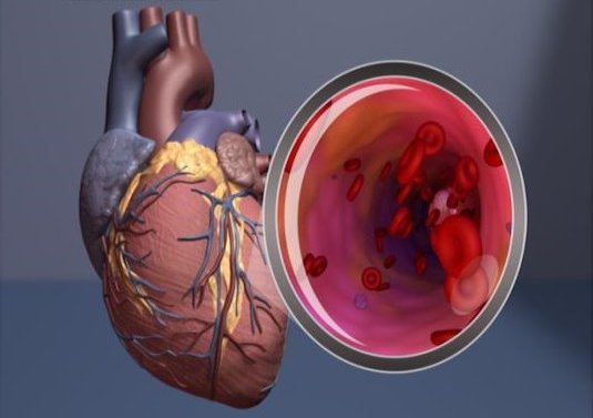 Heart illustration with magnification of the artery