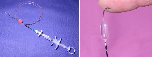 A ballon catheter for Ballon Dilatation for Bronchoscopy Delivery method. A...