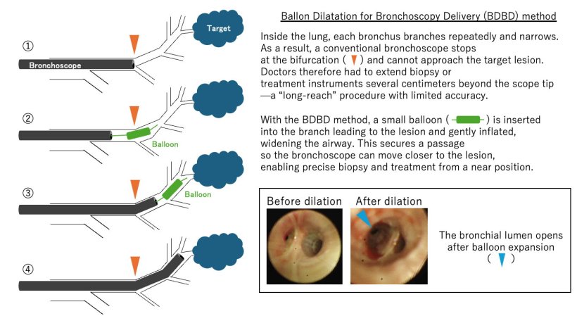 Ballon Bilatation for Bronchoscopy Delivery method