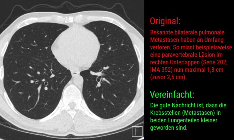 Beispiel für einen von der KI vereinfachten CT-Befund (das CT-Bild links zeigt...