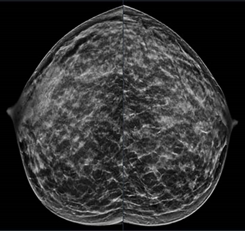 Mammography images of a woman with dense breast tissue