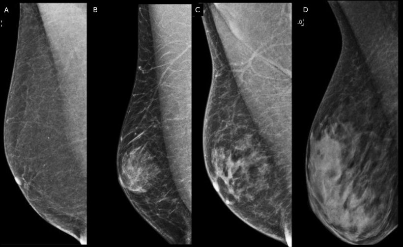 Right medio-lateral-oblique digital mammography of different types of male...