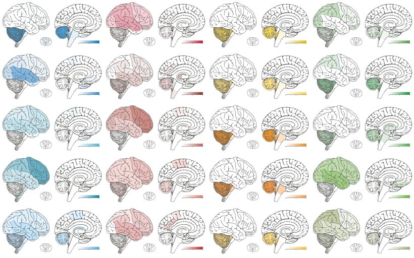 40 schematische Darstellungen von Gehirnen mit farblichen Markierungen in...