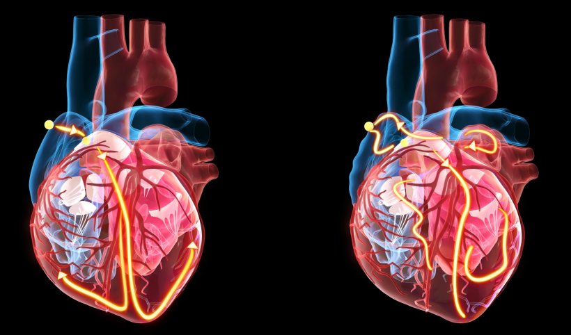 illustration of conduction system of the heart, healthy on the left, with...