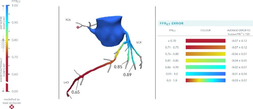 FFR-CT report example: A positive FFR-CT (centre panel). The LAD shows a...