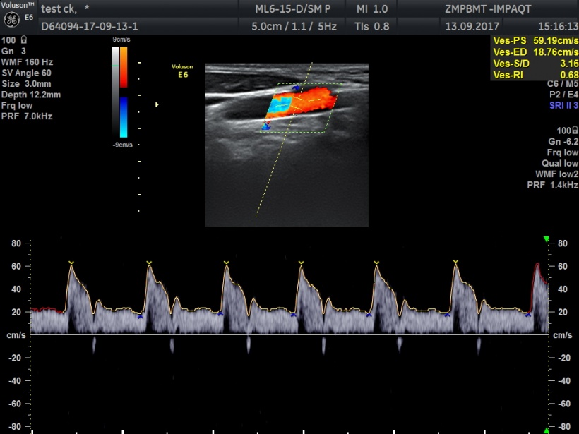 Example of automatic detection and evaluation of the flow curve with spectral...