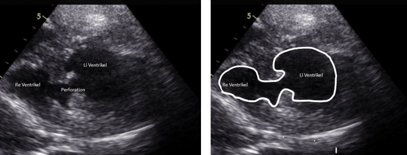 Ultrasound image of patient with severe shock