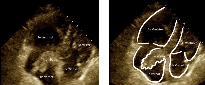 Ultrasound image of female patient with severe dyspnoea