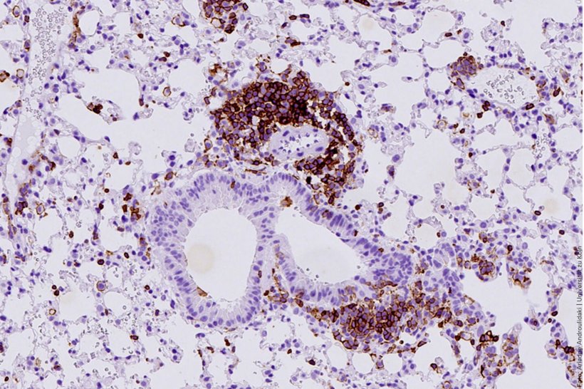 Lungengewebe einer Maus mit SCLC-Lungenkrebs. Die Gewebeprobe ist zur besseren...