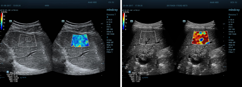 The future of elastography rides on the shear wave