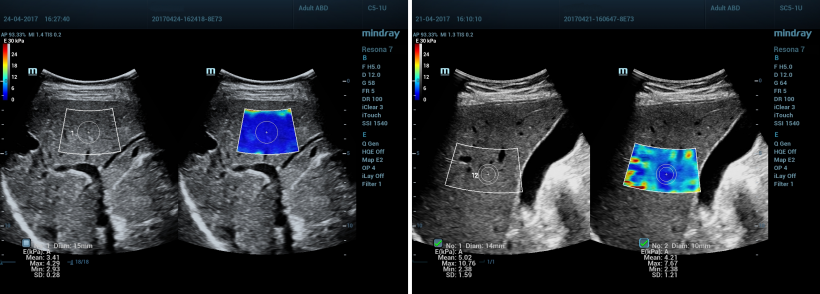 The future of elastography rides on the shear wave
