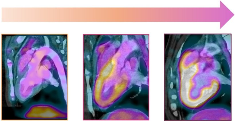 Three medical PET heart scans, with a color-gradient arrow above to indicate...