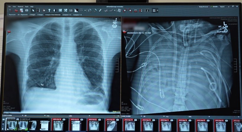 A computer monitor showing two xray images of a human thorax with lungs