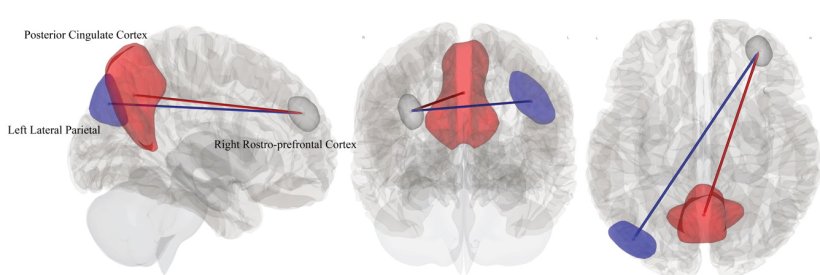 Three grey brain illustrations with highlighted areas in blue and red against a...