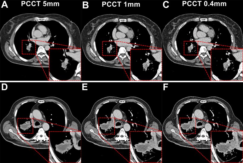 Six chest CT images arranged in a three-by-two grid. Relevant areas are...