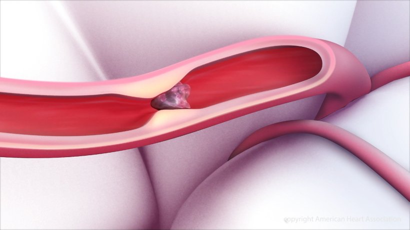 An illustration showing a clot within a blood vessel interrupting blood flow to...