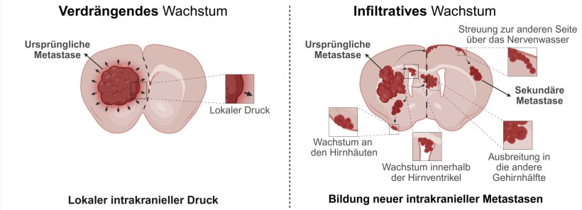 Zwei Illustrationen zeigen schematisch, wie sich Krebs durch Metastasen im...