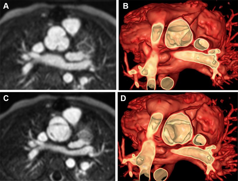 Four cardiac MRI images of a childs heart. The images on the right side have...