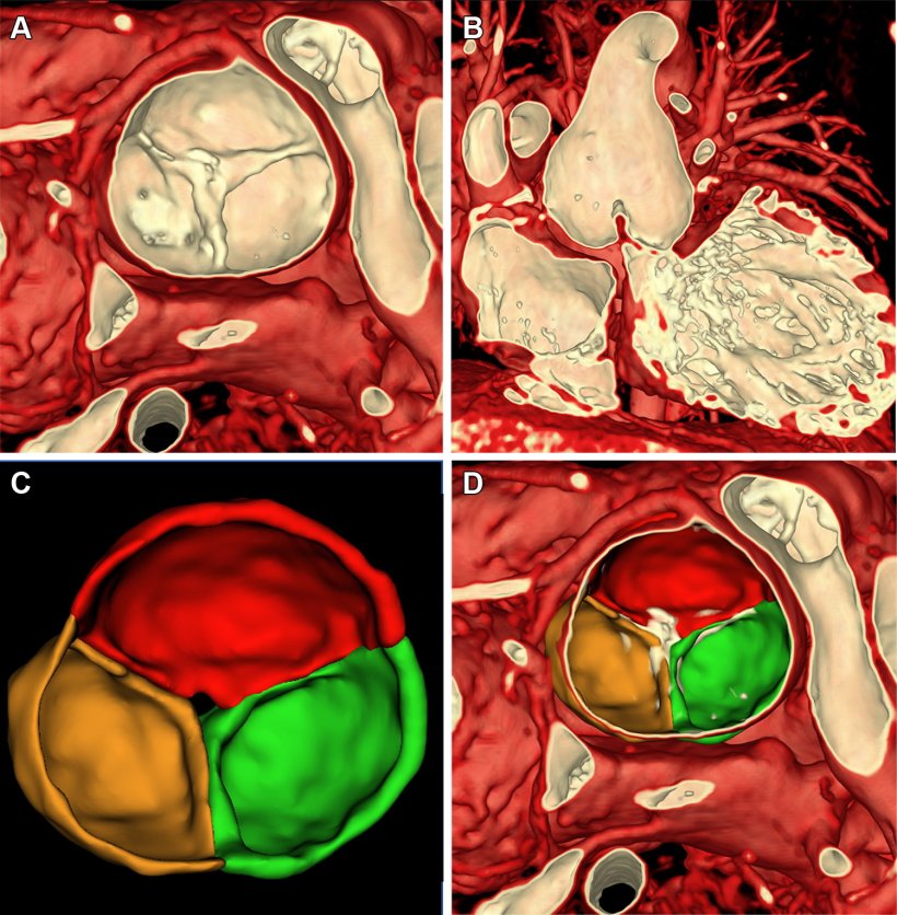 Four MRI scans of a girls heart, enhanced to display color and 3d structure, as...