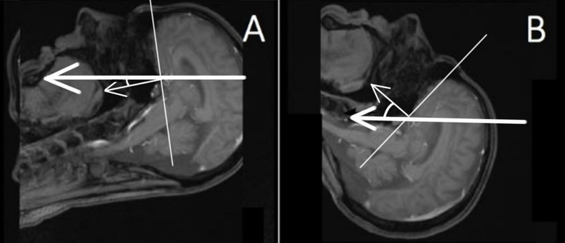 Zwei MRT-Aufnahmen eines Kopfes mit weißen Pfeilen, die die Position des...