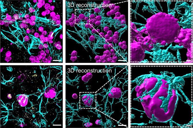 Die Forscher konnten zeigen, wie das Vorhandensein von Brustkrebszellen (lila)...