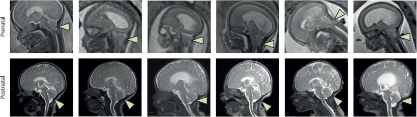 Twelve MRI scans of a babys and fetus brain with spina bifida, arranged in a...