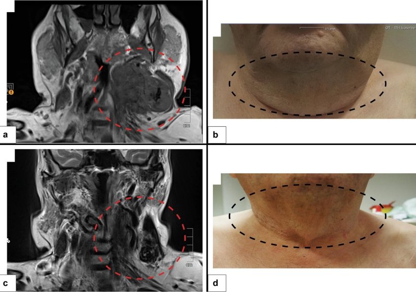Zwei MRT-Aufnahmen und zwei entsprechende Fotos eines Patienten mit...