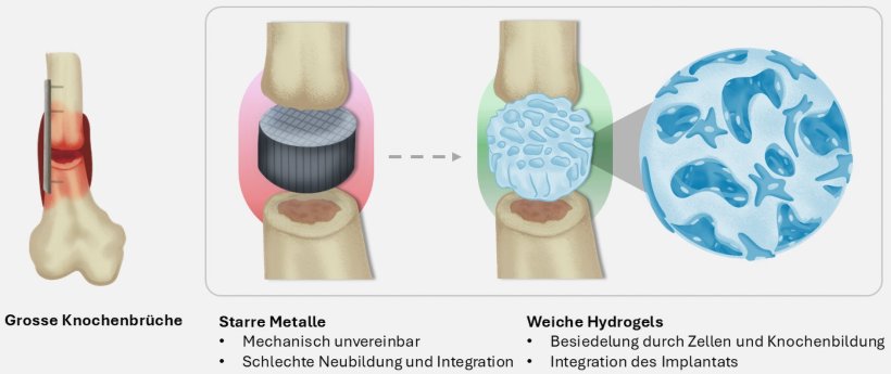 Um Knochen zu verbinden, werden heute harte steife Implantate verwendet...