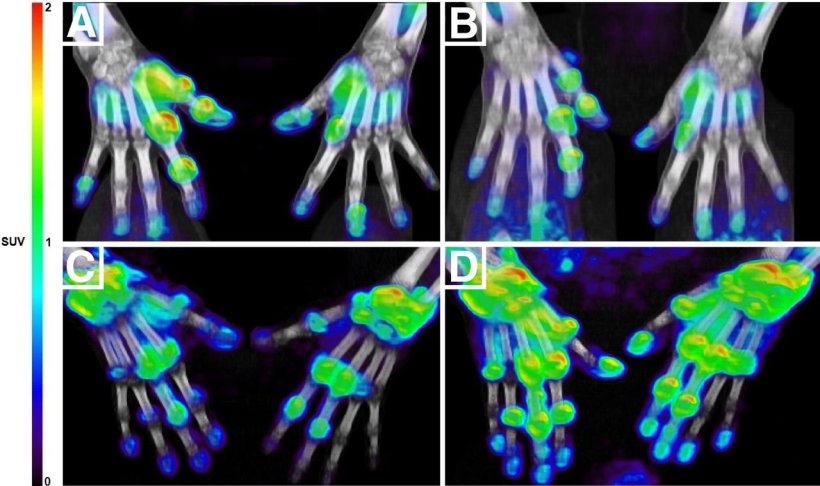 Four sets of PET/CT images of hands with colored areas marking rheumatoid...