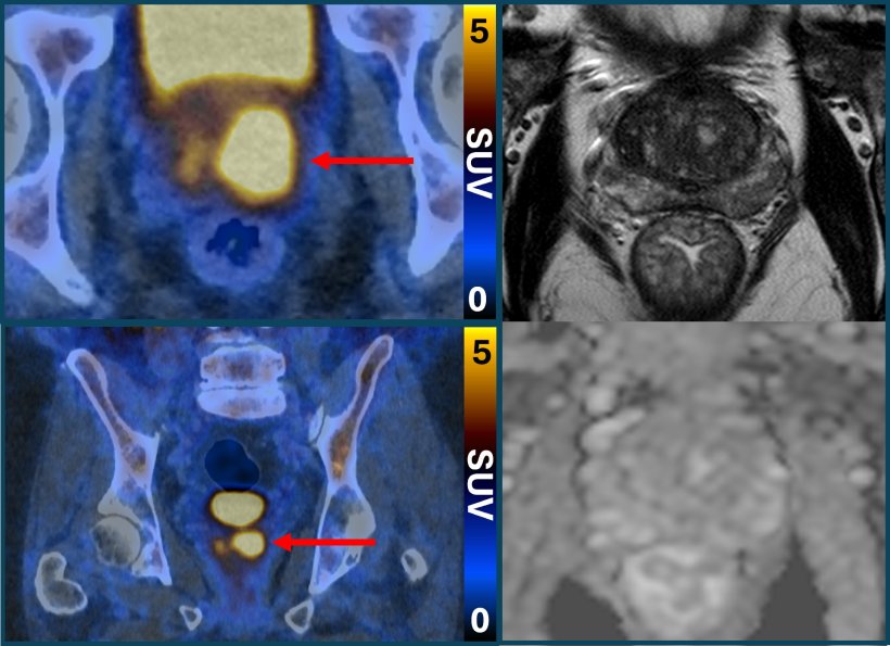 Side-by-side view of PSMA PET/CT scan and MRI scan of patient with prostate...