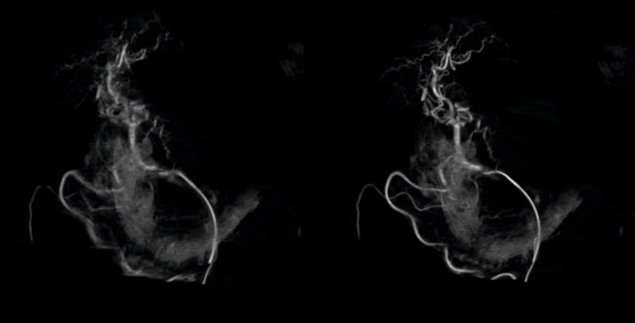 Syngo DynaCT MORE nutzt iterative Bildrekonstruktion für eine konsistente...