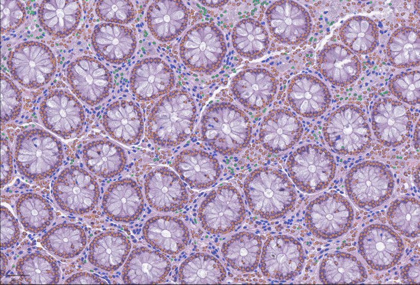Gewebeprobe aus dem Dickdarm für die Pathologie; ein Muster aus runden...