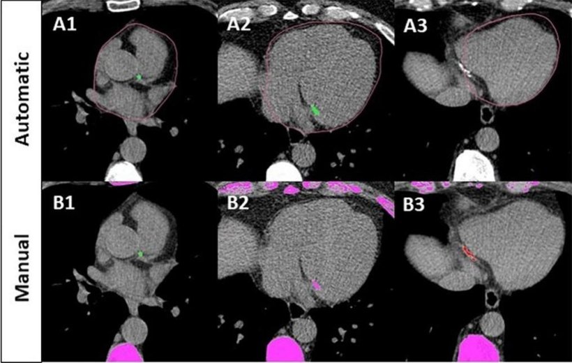 Six CT scans of humean hearts, arranged in a 3x2 grid