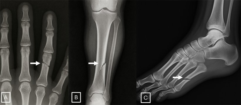 Examples of GPT-4o-generated radiographs of fractures: (A) posteroanterior...