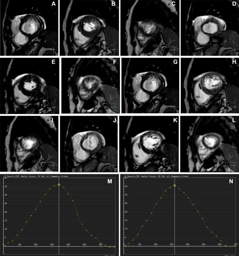Twelve MRI images of a heart, arranged in a 4x3 grid. Below, two sine curves...