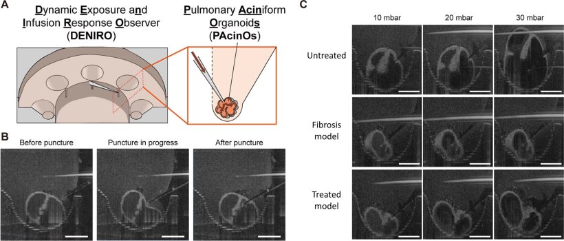 Intraluminal access and pressure application using the PAcinOs in DENIRO...