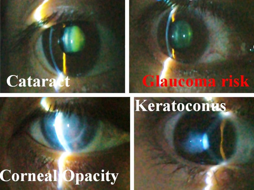 Four slit-scan images of eyes, with various ophthalmic conditions: Cataract,...