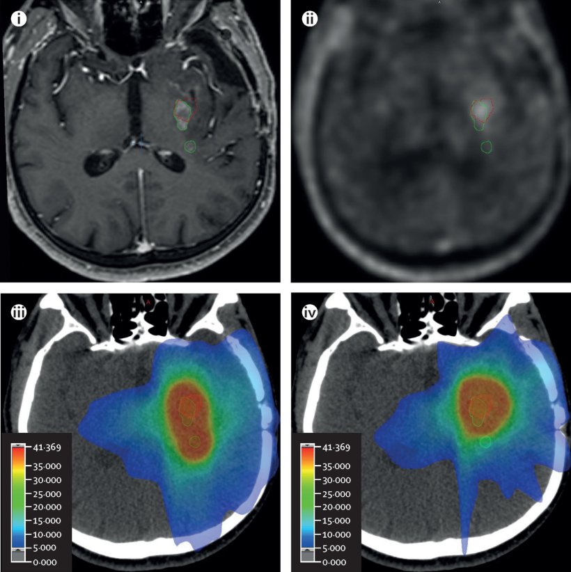 Vier medizinische Aufnahmen von Gehirnen von Patienten mit Glioblastom in...