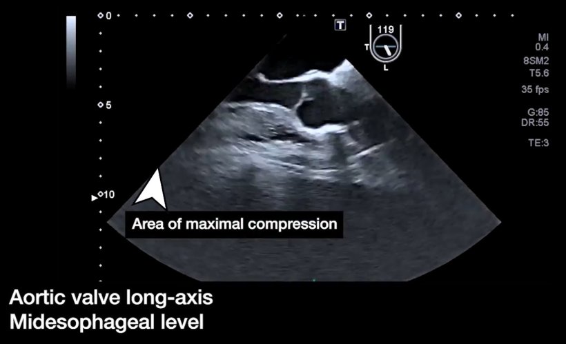 An ultrasound image of a thorax, with a white arrow indicating the area of...