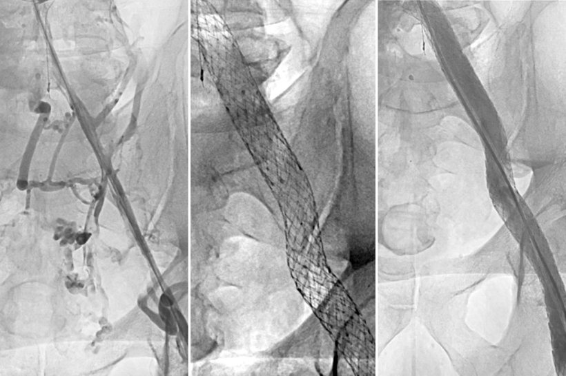 Three angiography images of a patient with deep vein thrombosis before and...