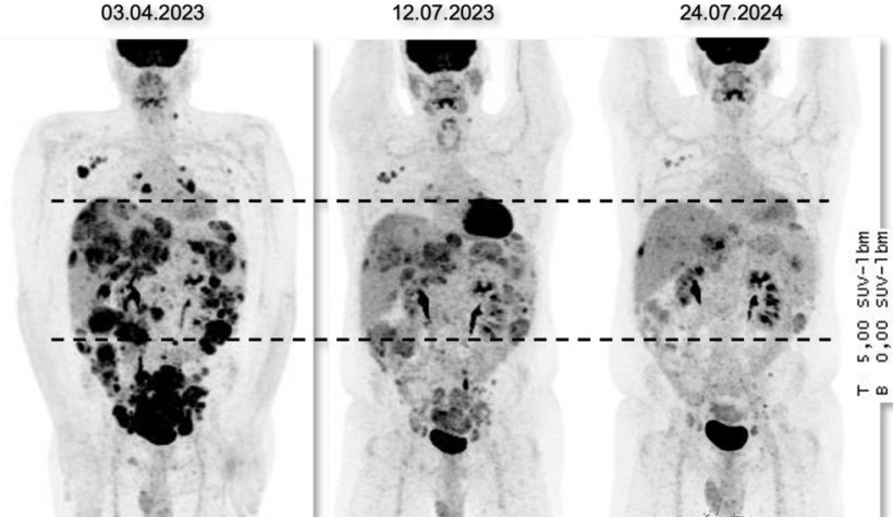 PET-Aufnahmen (Positronen-Emissions-Tomografie) eines Patienten zu drei...