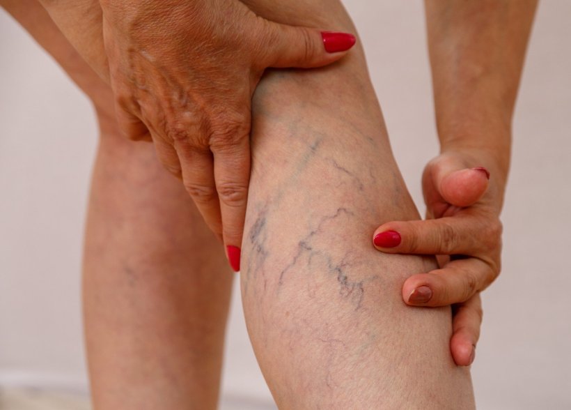 Die Beine einer Frau mit Krampfadern. Die Frau hält sich mit beiden Händen...