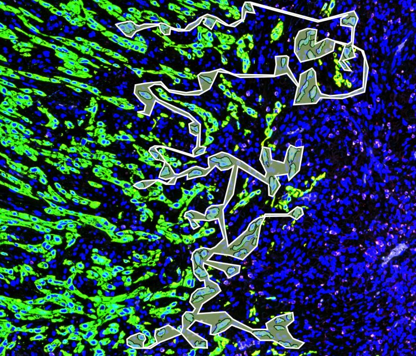 Gewebeschnitt eines Kopf-Hals-Tumors mit markierten Tumorknospen und...