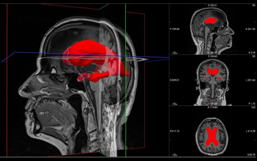 3D MRI scan of the head of a hydrocephalus patient. The central part is...
